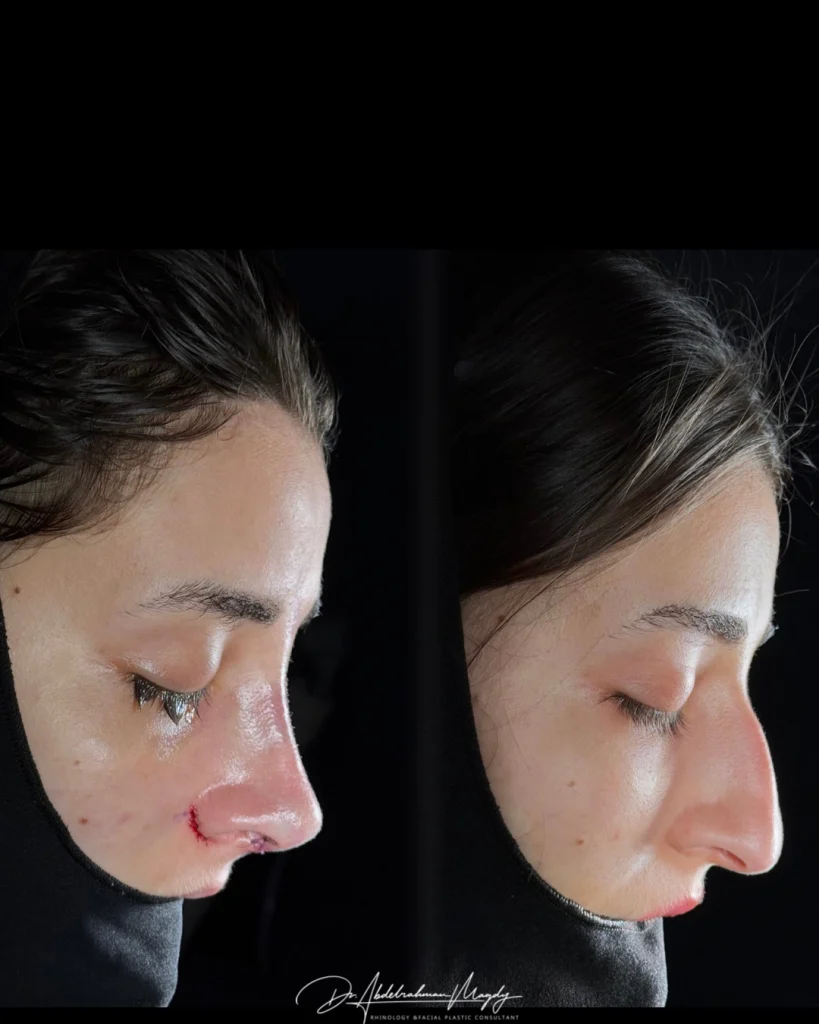 جراحات تجميل الانف فى مصر