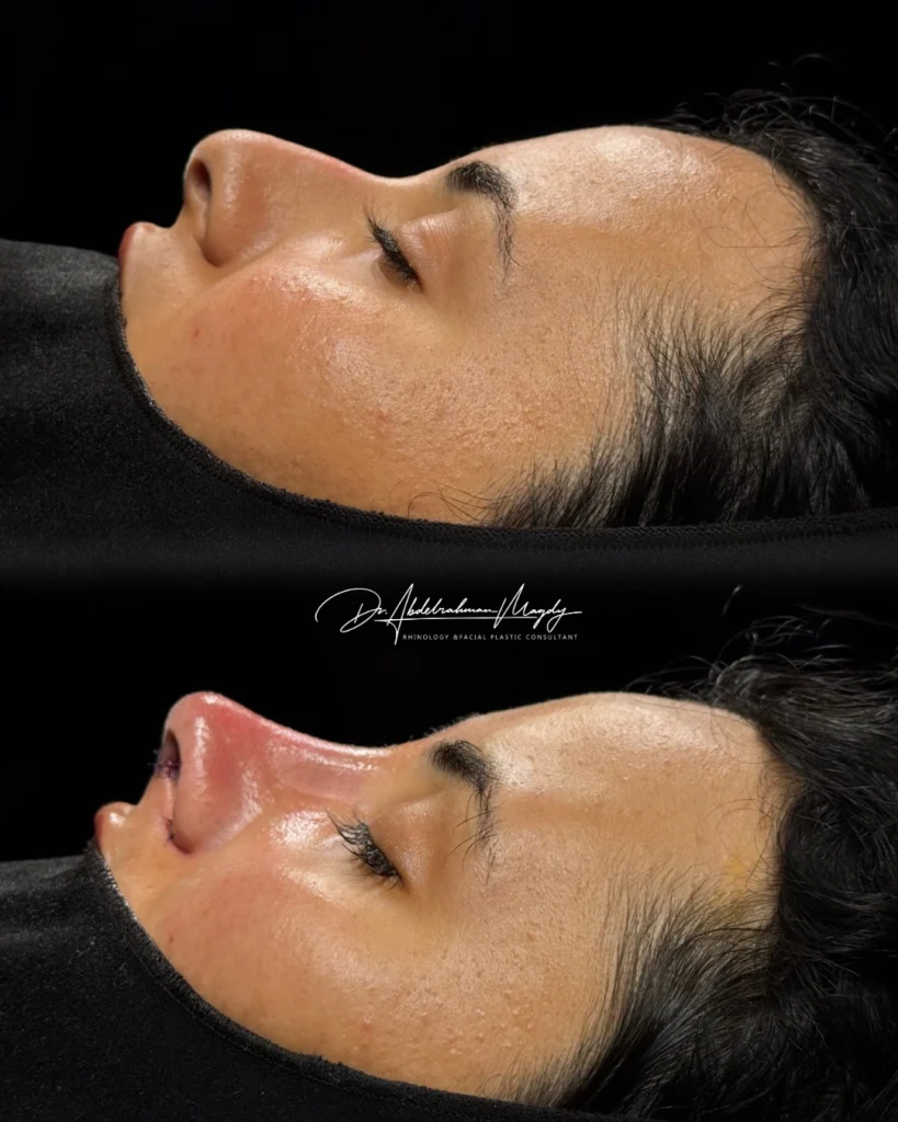 اسعار عمليات تجميل الانف في مصر